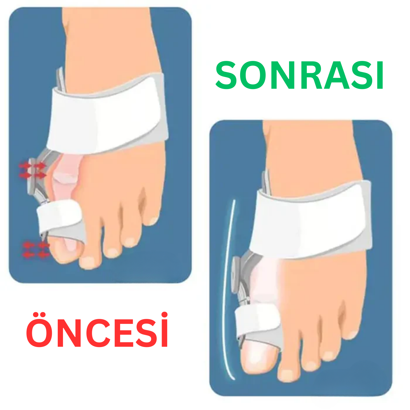 Halluks Balgus (Bunyon) Ayak Başparmağı Çıkıntısı Düzeltici - SupRelax